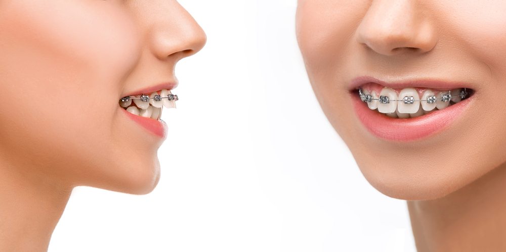 Common Orthodontic Problems - Murfreesboro, TN - Children ...